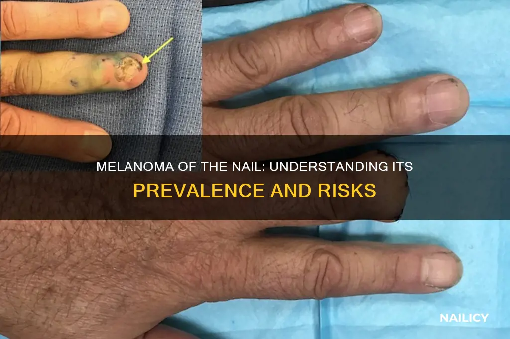 how common is melanoma of the nail