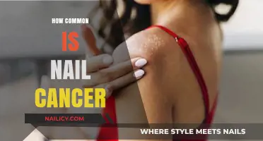 Understanding Nail Cancer: Prevalence, Risks, and Early Detection Tips