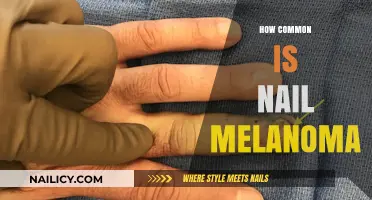 Understanding Nail Melanoma: Prevalence, Risks, and Early Detection Tips