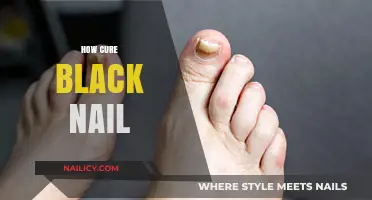 Effective Remedies to Treat and Cure Black Nails Naturally