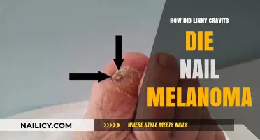 Linny Cravits' Tragic Death: Nail Melanoma Explained and Prevented