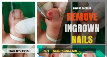 Expert Ingrown Nail Removal: What You Need to Know