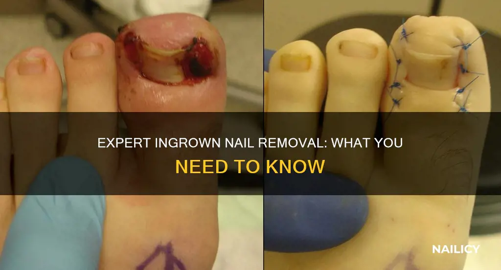 how do doctors remove ingrown nails