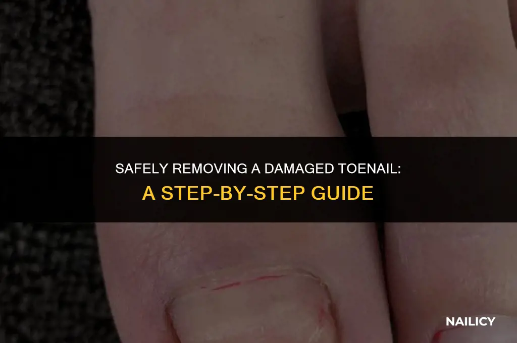 how do i get a damaged toe nail off