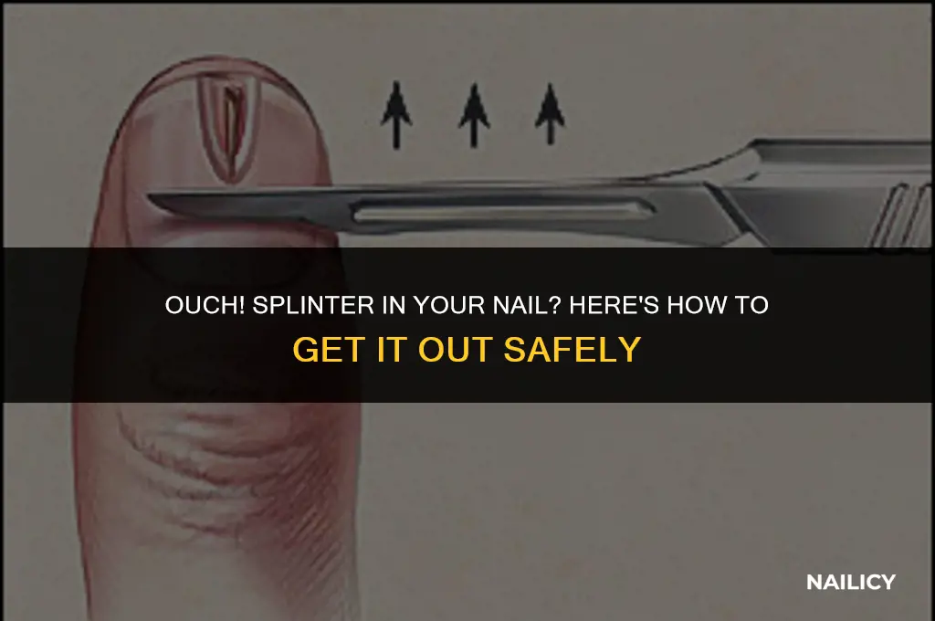 how do i get a splinter out of my nail