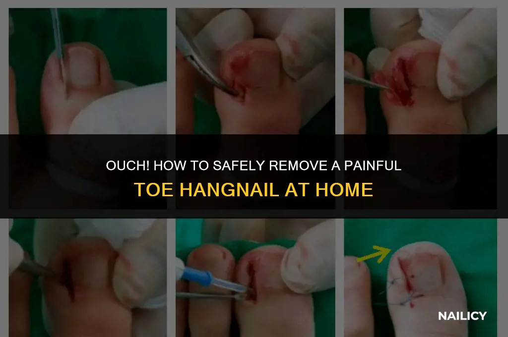 how do i get a toe hang nail out