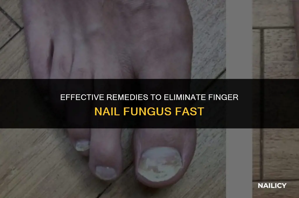 how do i get rid of finger nail fungus