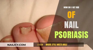Effective Ways to Manage and Treat Nail Psoriasis