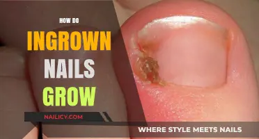Ingrown Nails: Causes, Prevention, and Treatment