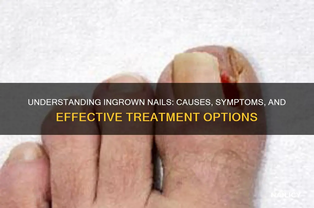 how do ingrown nails work