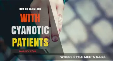 Cyanotic Patients' Nail Changes: Understanding Color and Health Indicators