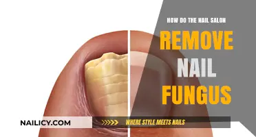 Nail Salon Nail Fungus Removal: What You Need to Know