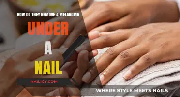 Melanoma Removal: Under the Nail