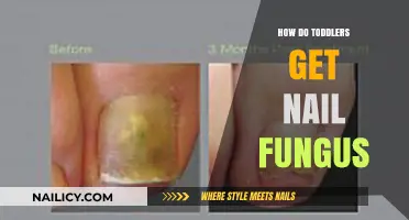 Tiny Toes, Big Troubles: Understanding Nail Fungus in Toddlers