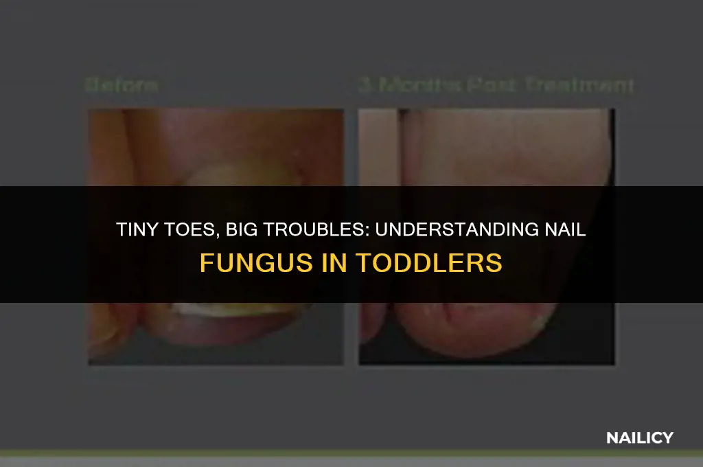 how do toddlers get nail fungus