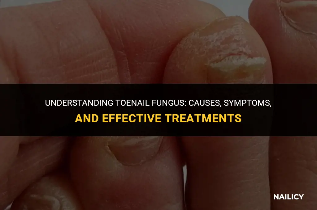 how do u get toe nail fungus