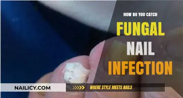 Understanding Fungal Nail Infections: Causes, Symptoms, and Prevention Tips