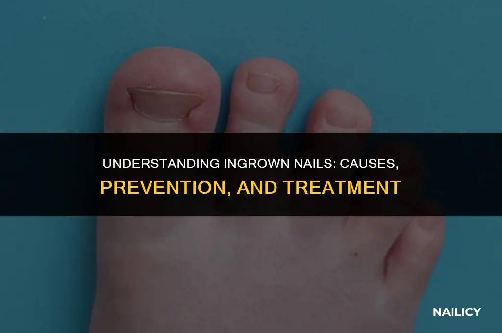 how do you get an ingrown nail