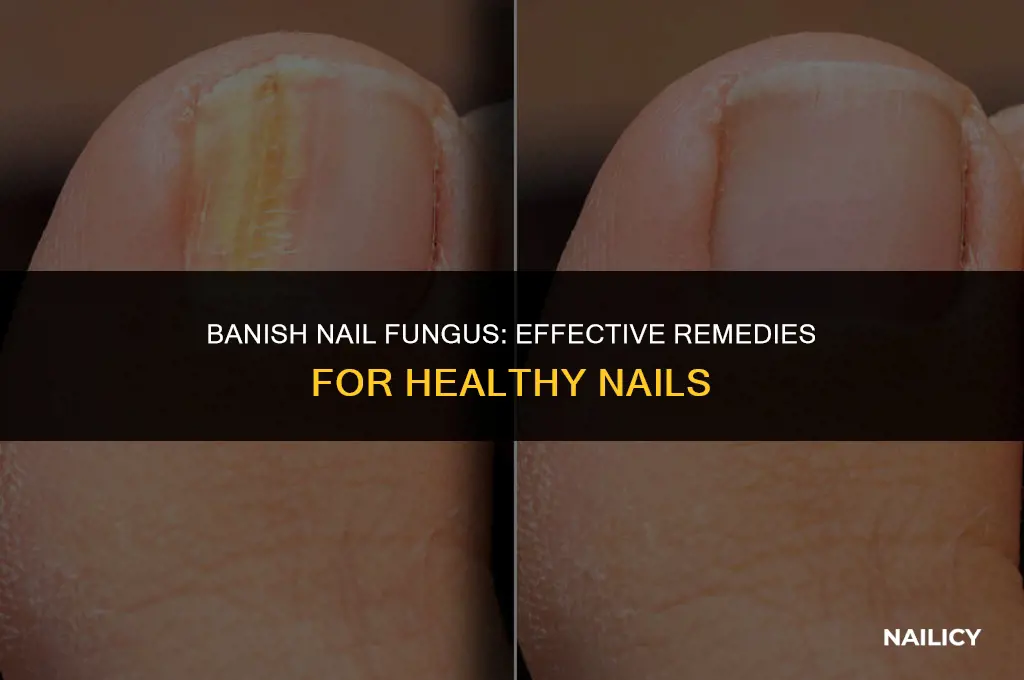 how do you get fungus off your nails