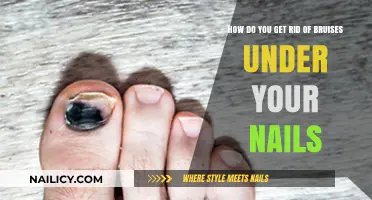 Quick Remedies to Heal and Hide Bruises Under Your Nails