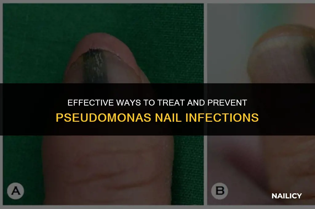 how do you get rid of pseudomonas nails