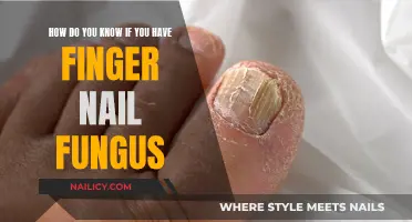 Recognizing Fingernail Fungus: What Are the Signs?