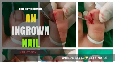 Treating Ingrown Nails: Effective Home Remedies and Professional Care