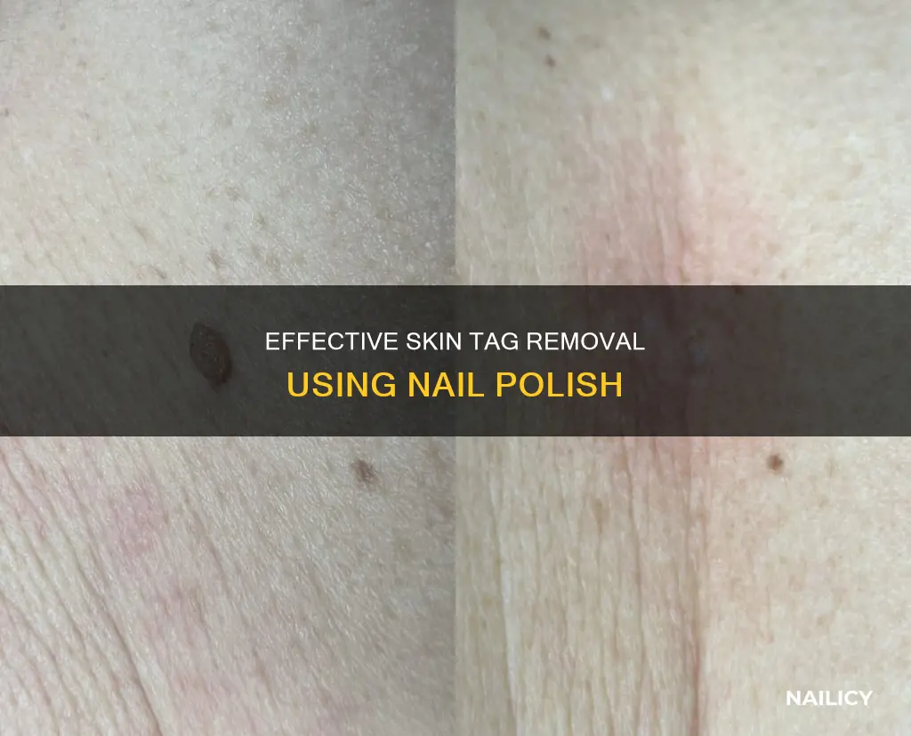 how do you remove skin tags with nail polish