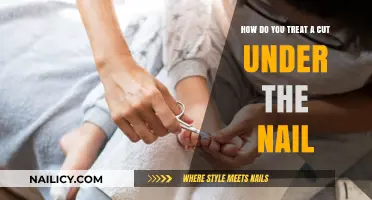 Treating Cuts Under Nails: Quick Home Remedies