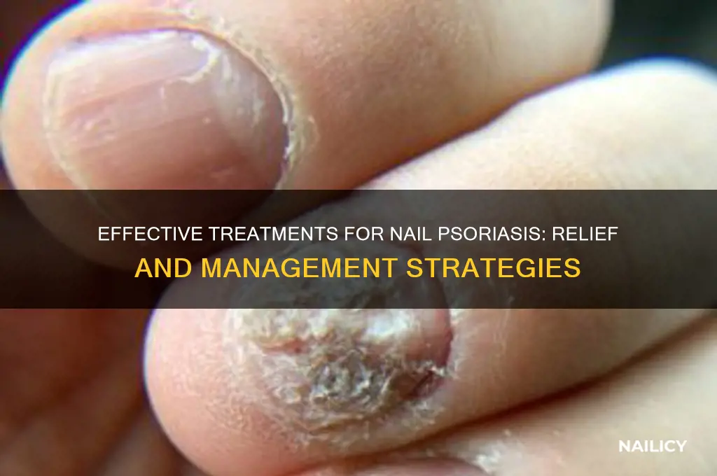 how do you treat psoriasis of the nails