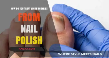 Treating White Toenails: Effective Remedies for Nail Polish Discoloration