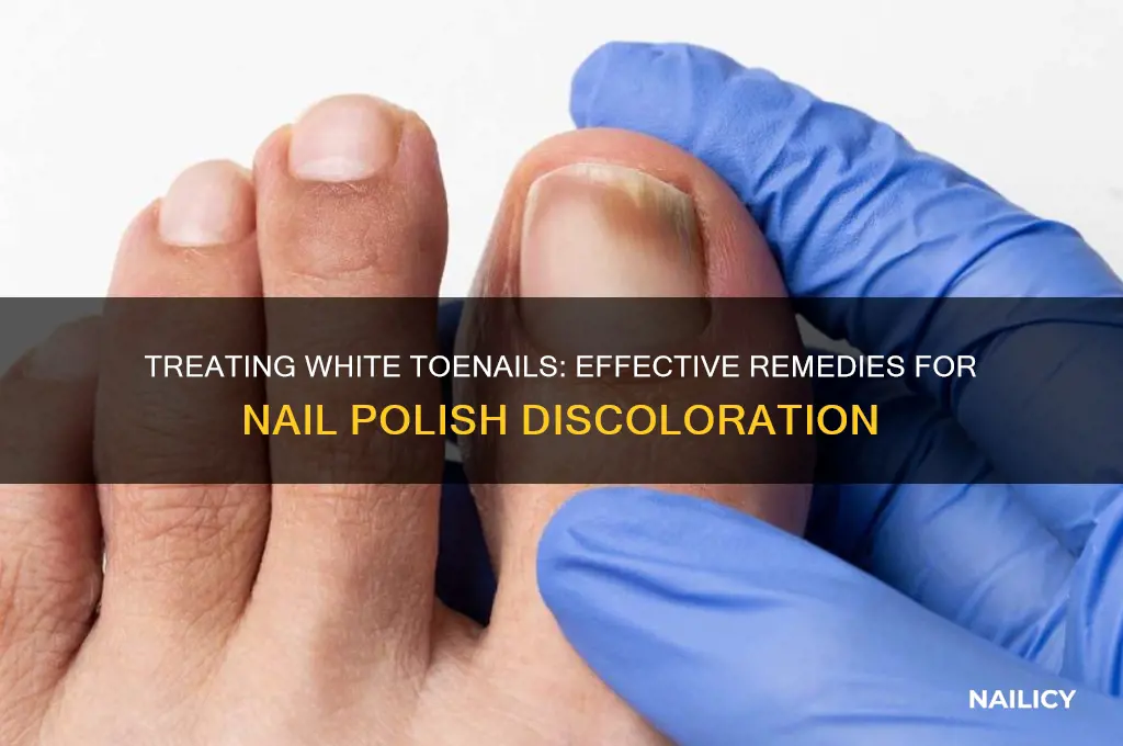 how do you treat white toenails from nail polish