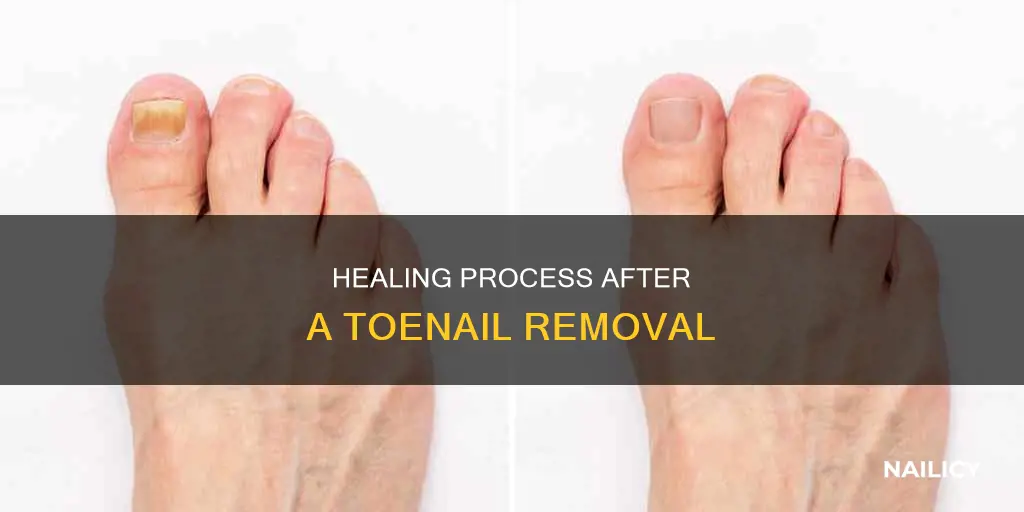 how does a removed toe nail heel