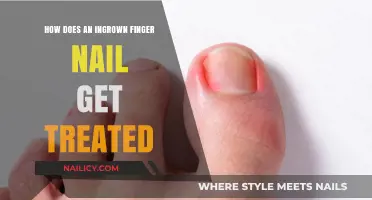 Treating Ingrown Fingernails: A Comprehensive Guide to Relief and Prevention