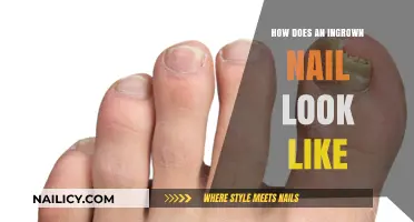 Identifying Ingrown Nails: Visual Guide to Symptoms and Appearance