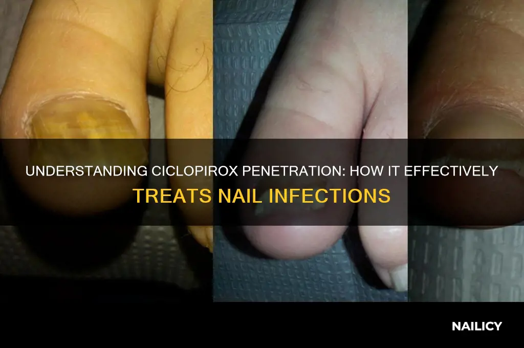 how does ciclopirox go through the nail