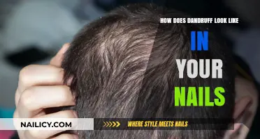 Unusual Nail Changes: Identifying Dandruff-Like Symptoms on Your Fingernails