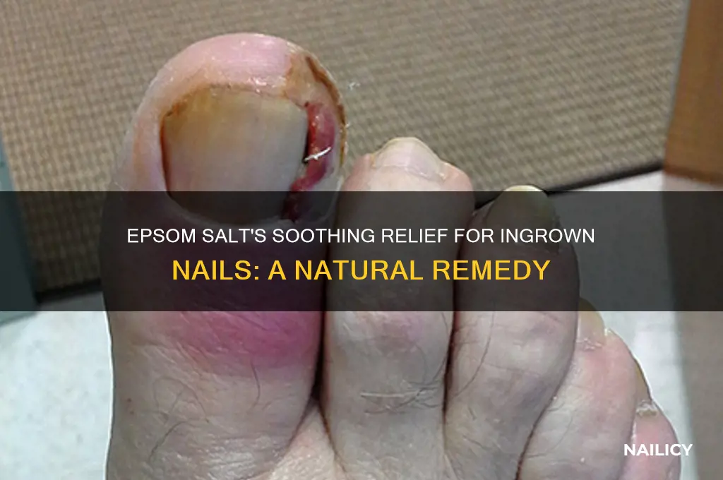 how does epsom salt help ingrown nail