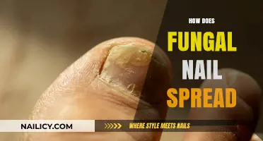 Understanding Fungal Nail Infections: Causes, Spread, and Prevention Tips