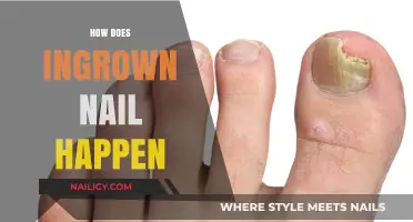 Understanding Ingrown Nails: Causes, Prevention, and Effective Treatment Options