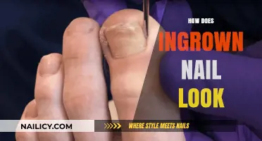 Identifying Ingrown Toenails: Visual Guide to Symptoms and Appearance