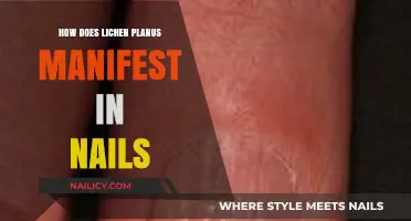 Understanding Nail Lichen Planus: Symptoms, Appearance, and Diagnosis Explained