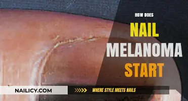 Understanding Nail Melanoma: Early Signs, Causes, and Prevention Tips