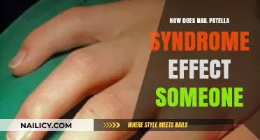 Understanding Nail Patella Syndrome: Impact on Physical Health and Daily Life