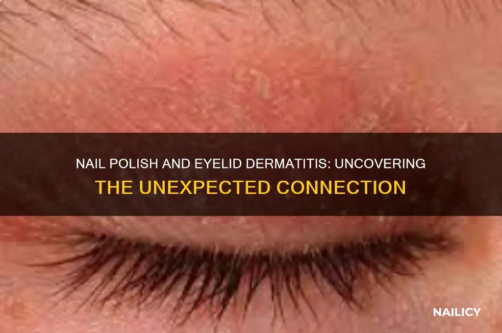 how does nail polish cause eyelid dermatitis