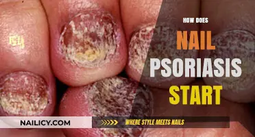 Understanding Nail Psoriasis: Early Signs, Causes, and Triggers Explained