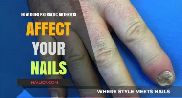 Psoriatic Arthritis and Nail Health: Symptoms, Impact, and Management Tips