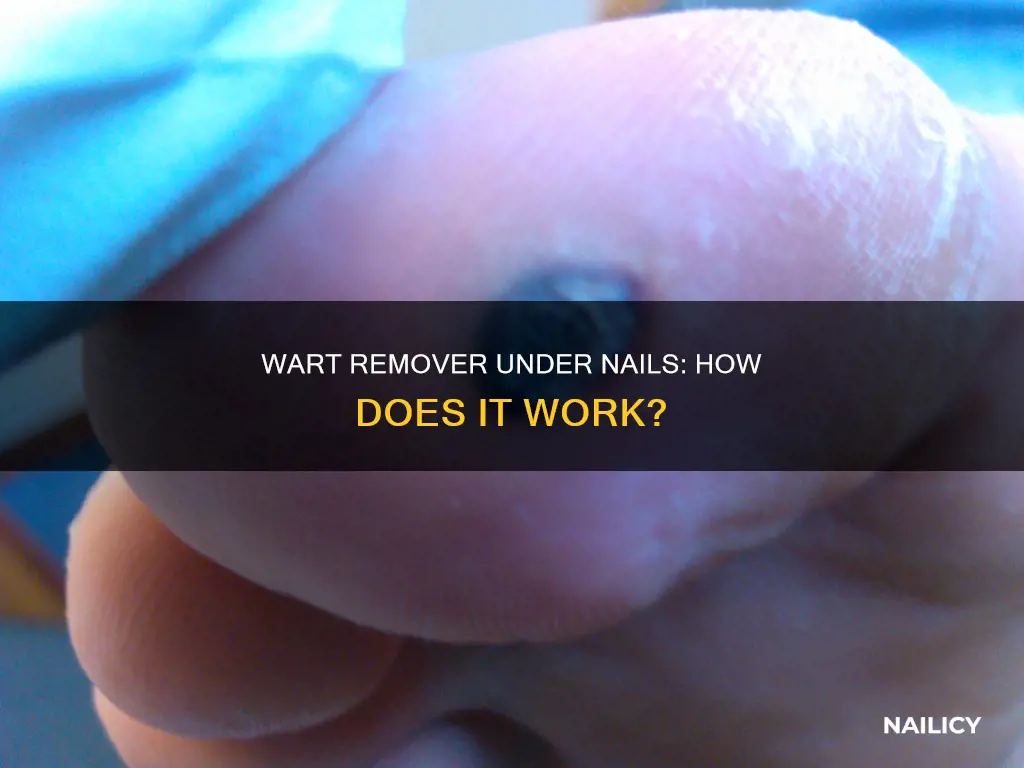 how does wart remover work under nail