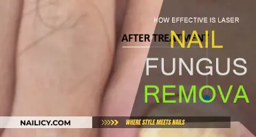 Laser Nail Fungus Removal: Does It Work?