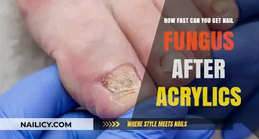 From Glamour to Green: The Swift Onset of Nail Fungus Post-Acrylics